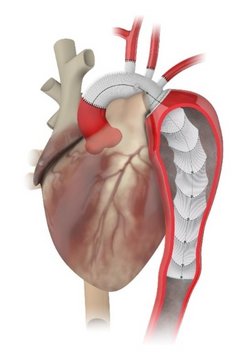 Thorakale Aorta mit Aneurysma der Aorta descendens und einem implantiertem Thoraflex-Hybridprothese