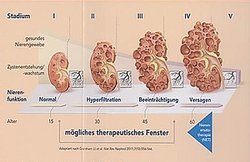 Bild zeigt Stadien von Zystenwachstum an der Niere und deren Beeinträchtigung der Nierenfunktion