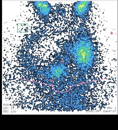 Schilddrüsenszintigraphie mit Tc-99m-Pertechnetat: Großer kalter Knoten im rechten Schilddrüsenlappen.