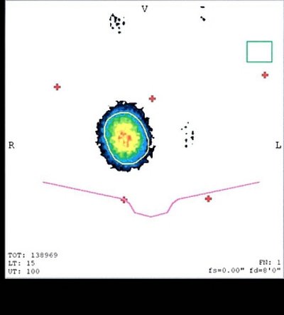 Schilddrüsenszintigraphie mit Tc-99m-Pertechnetat: Fokale Autonomie.