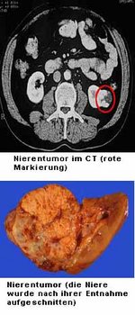 Nierenzellkarzinom