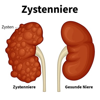 Bild zeigt eine Zystenniere und eine gesunde Niere