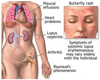 Lupus erythematodes