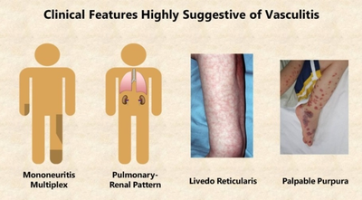 Vasculitis