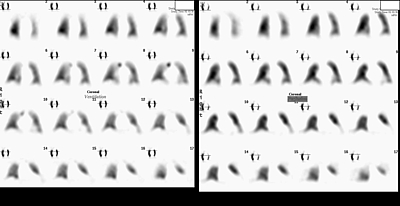 Bild zeigt Ventilations- (linke Serie) und Perfusionsszintigraphie: Normalbefund.
