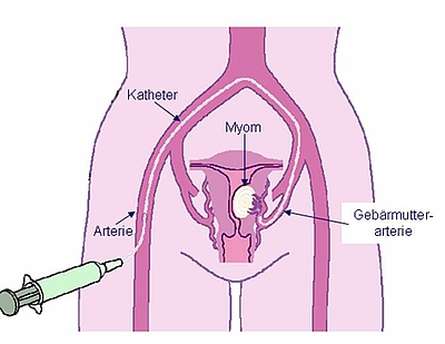 Grafik zeigt einzelne Schritte einer Embolisation