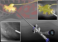 Große Steine werden mit einem pneumatischen Stab oder einer saugenden Ultraschallsonde zerkleinert.